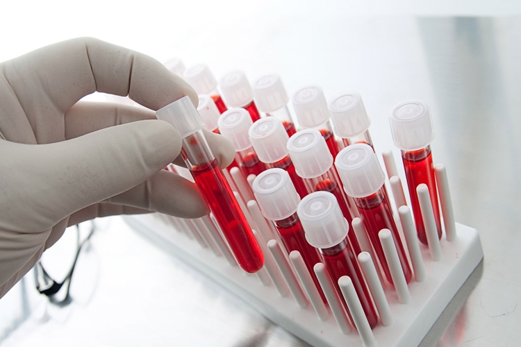 Ferritin Testi Aç Karnına Mı Yapılır?