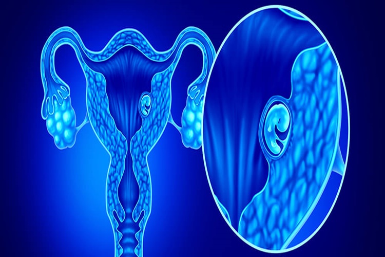 Fetal Redüksiyon Kaçıncı Haftada Yapılır?