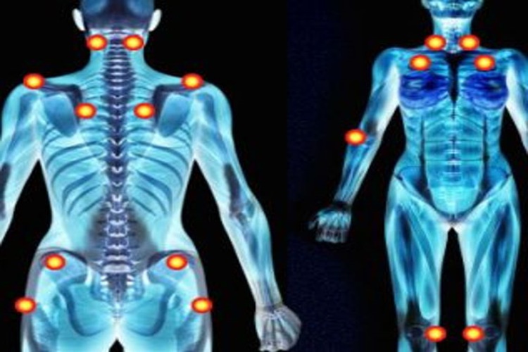 Fibromiyalji Nasıl Tedavi Edilir?