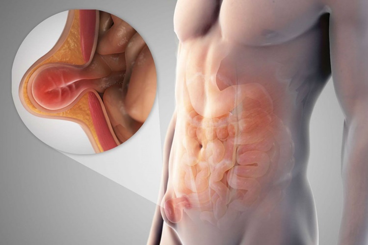 Fıtık Ödem Yapar Mı?