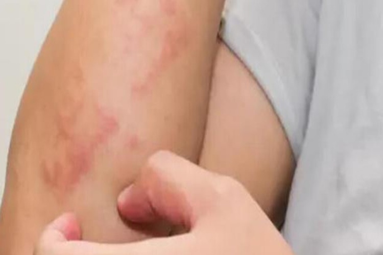 Flagyl Alerji Yapar Mı?