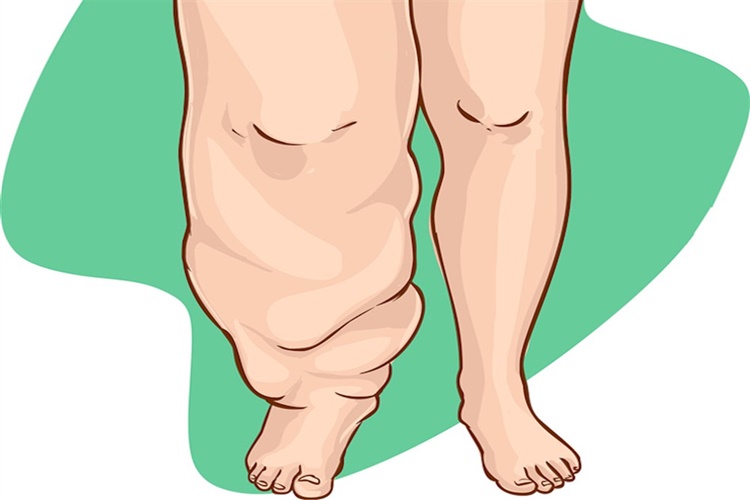 Flagyl Ödem Yapar Mı?