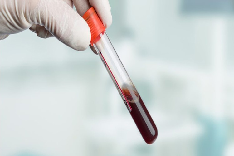 Genetik Testi İçin Kan Aç Karnına Mı Yapılır?