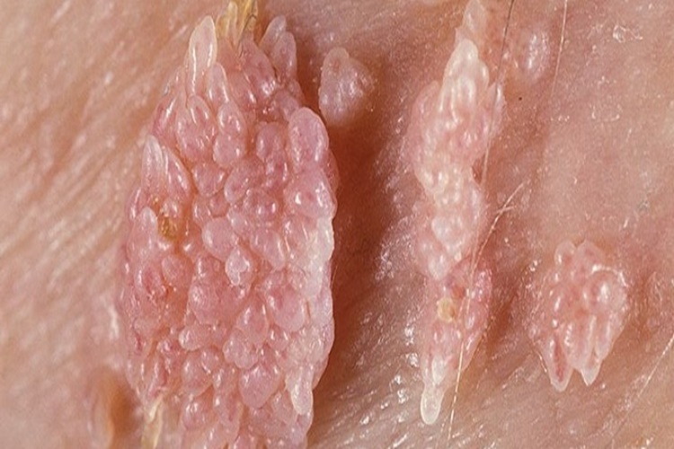 Genital Siğil Dondurma Acıtır Mı? 