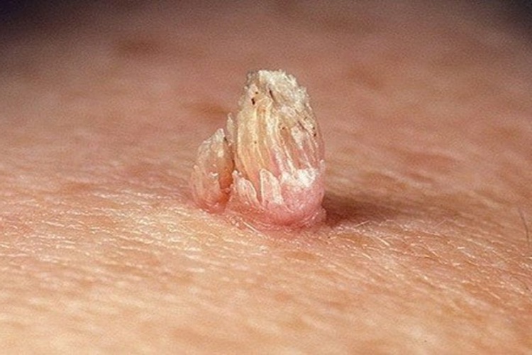 Genital Siğil Hangi Yollarla Bulaşır?
