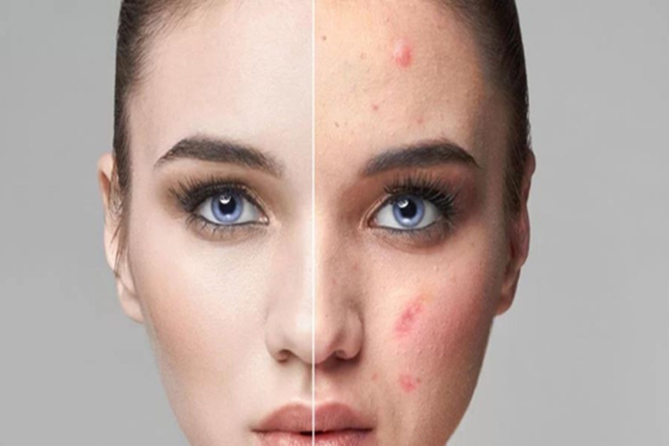 Güneş Lekesi İçin Hangi Serum?