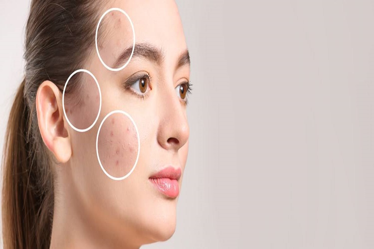 Güneş Lekesi Olmaması İçin Ne Yapmalı?