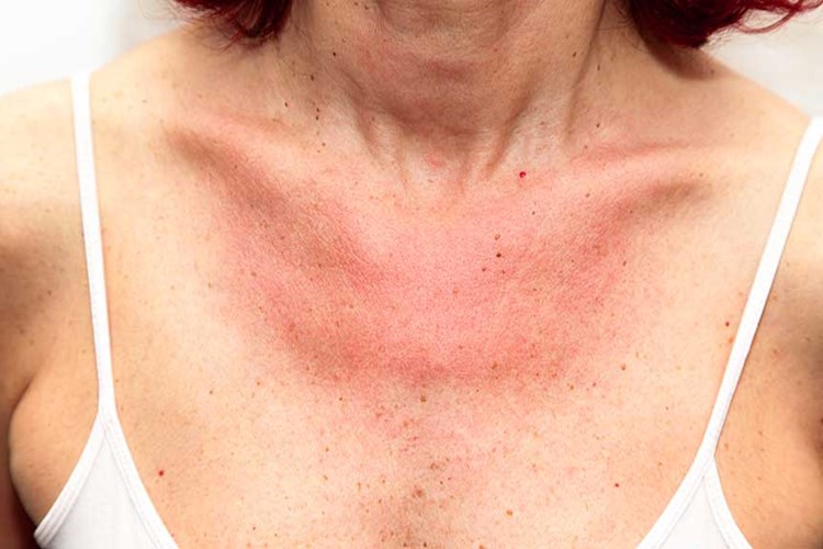 Hametan Krem Alerji Yapar Mı?