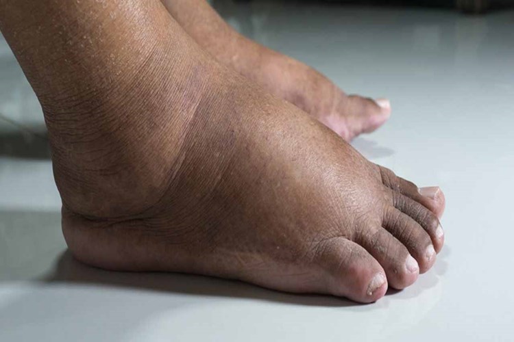 Hametan Krem Şişliğe İyi Gelir Mi?