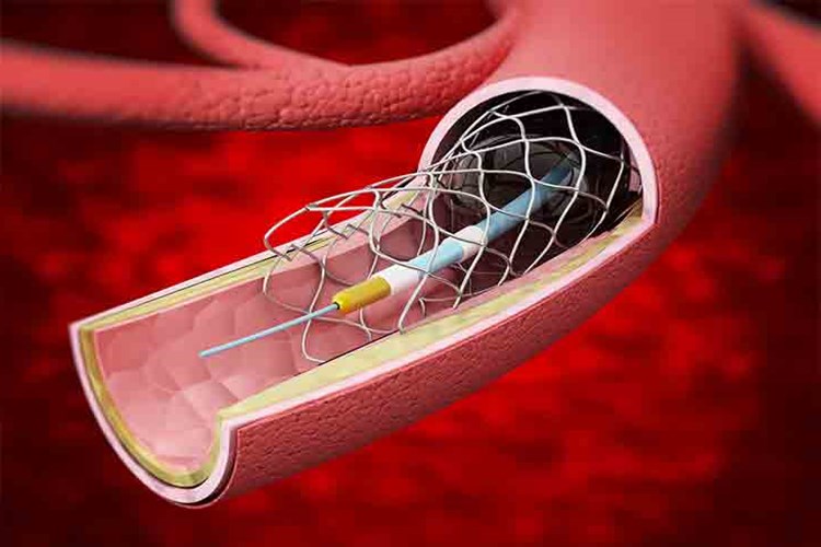 Hamilelikte Böbreğe Stent Takılması Zararlı Mı?