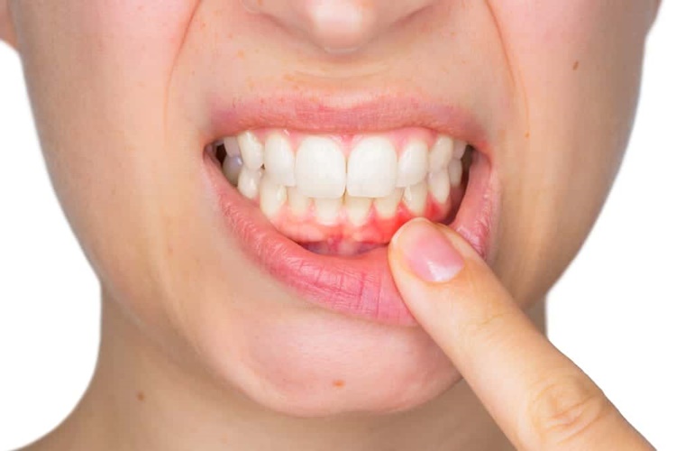 Hamilelikte Diş Ağrısı Hangi Vitamin Eksikliğinden Olur?