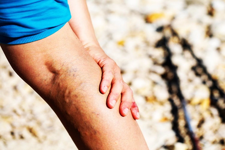 Hamilelikte Varis Neden Olur?