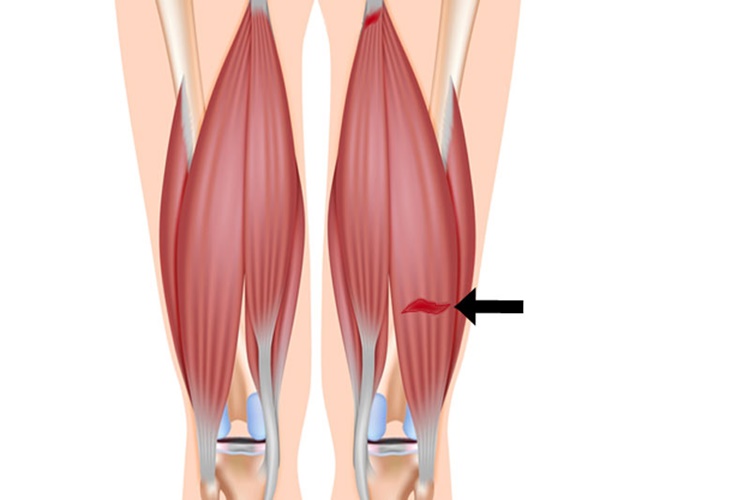 Hamstring Sakatlığı Ne Kadar Sürer?