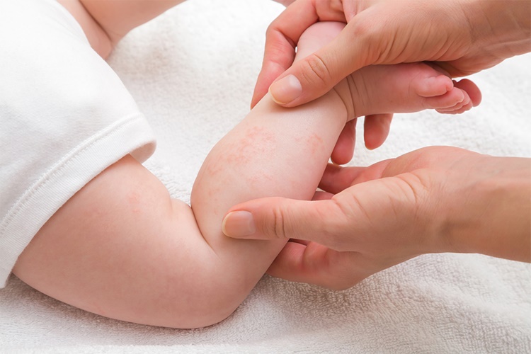  Hangi Besinler Pişik Yapar?