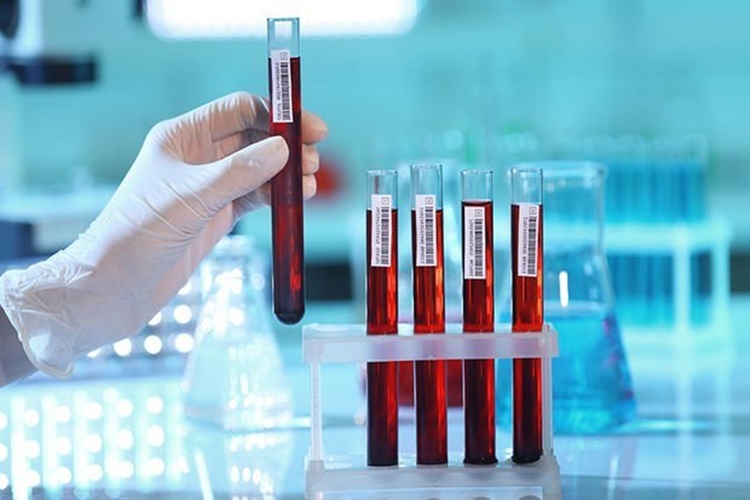 Hemoglobin Elektroforezi Testi Neden Yapılır?