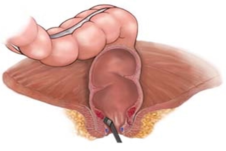 Hemoroid İltihap Yapar Mı?