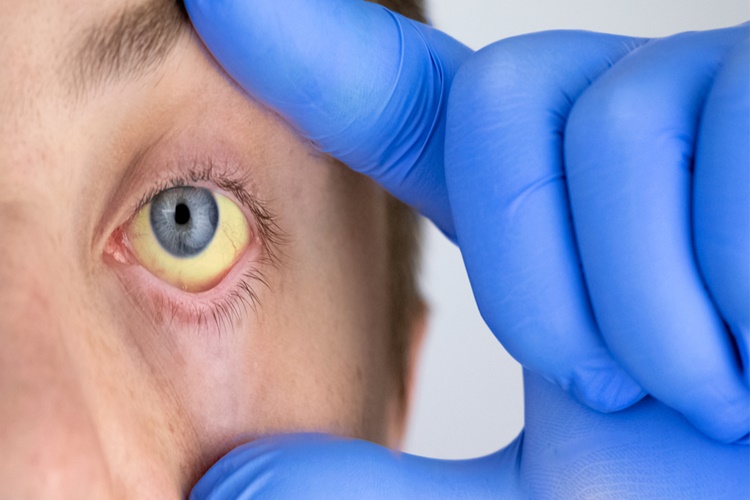 Hepatit A Belirtileri Nelerdir?