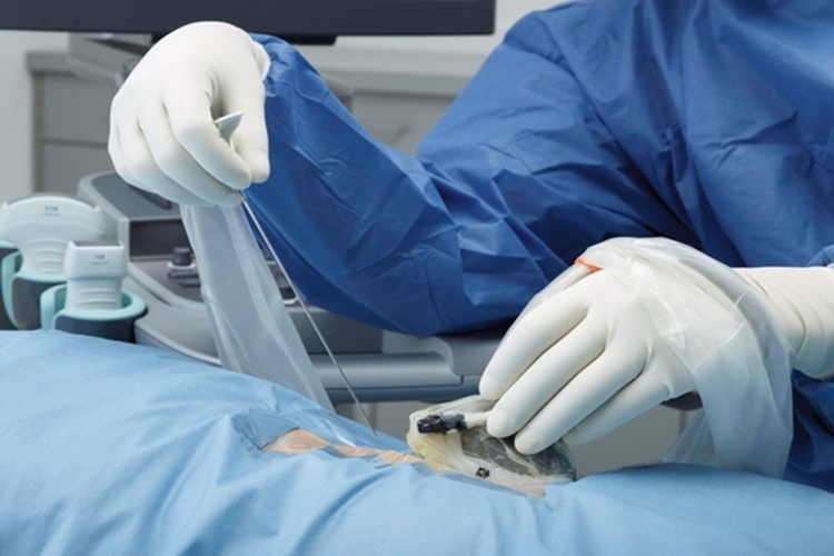 Hepatit B Biyopsi Neden Yapılır?