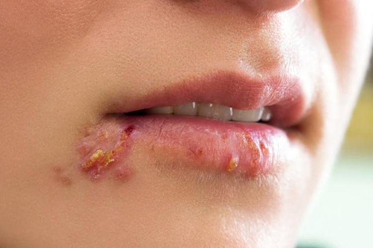 Herpes Virüsü İnsana Bulaşır Mı?