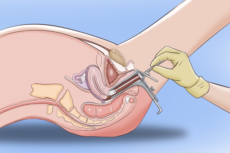 Hpv Testi İle Smear Testi Aynı Mı?