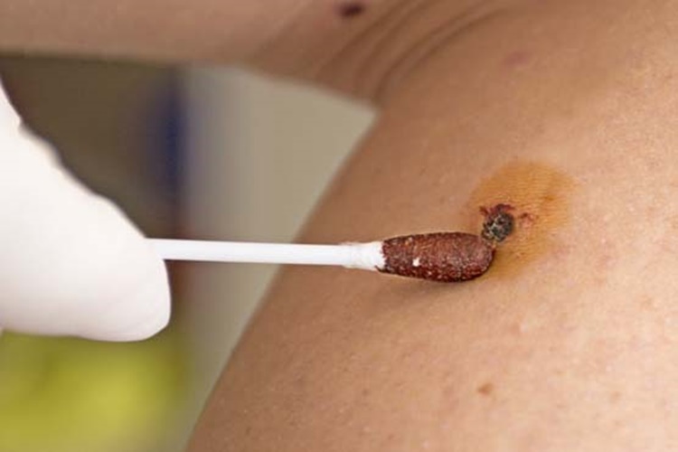 HPV Virüsü Tedavisi Var Mı?