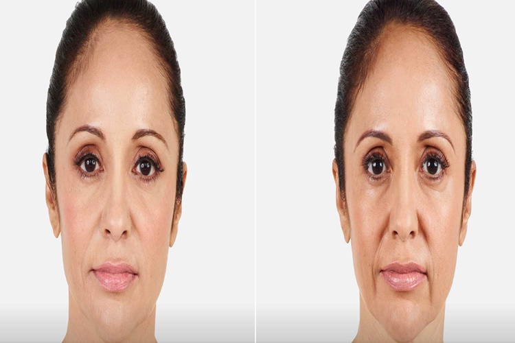Hyaluronik Asit Zararlı Mıdır?