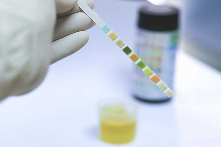 İdrar Testi Tok Karnına Yapılır Mı?