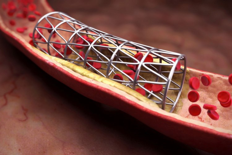 İdrar Yoluna Stent Takıldıktan Sonra Katı Mı Sıvı Mı Beslenmek Gerekir?
