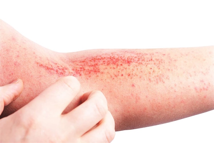 İlaç Alerjisi Deri Döküntüsü Nasıl Geçer?