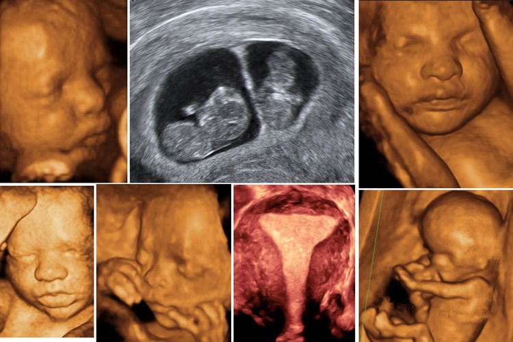 İlk Haftalarda Bebek Ultrasonda Görülür Mü?