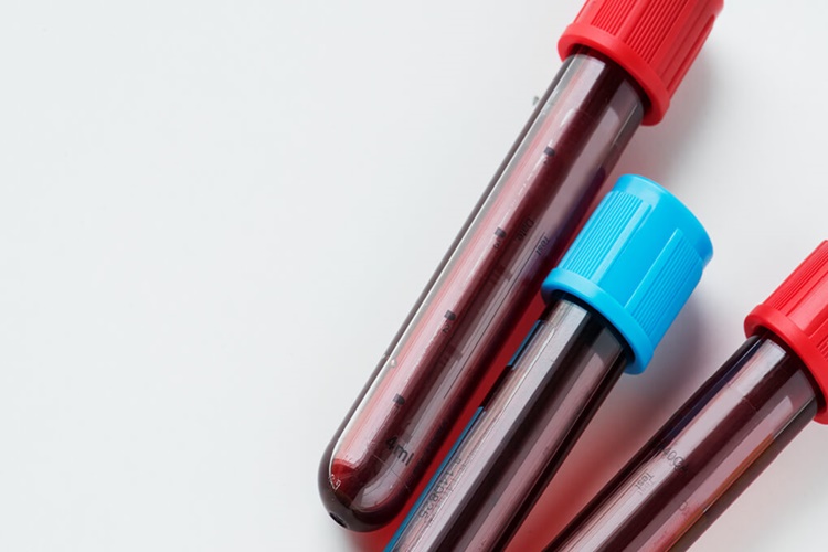 İndirekt Coombs Testi Neden Yapılır?