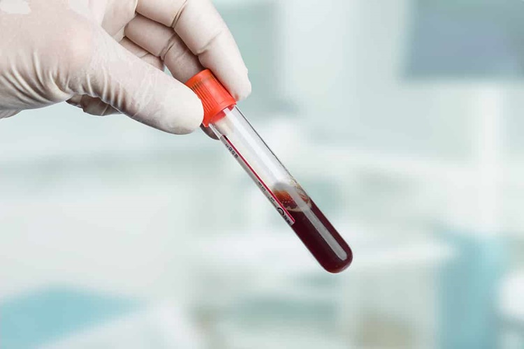 İntolerans Testi Nasıl Yapılır?