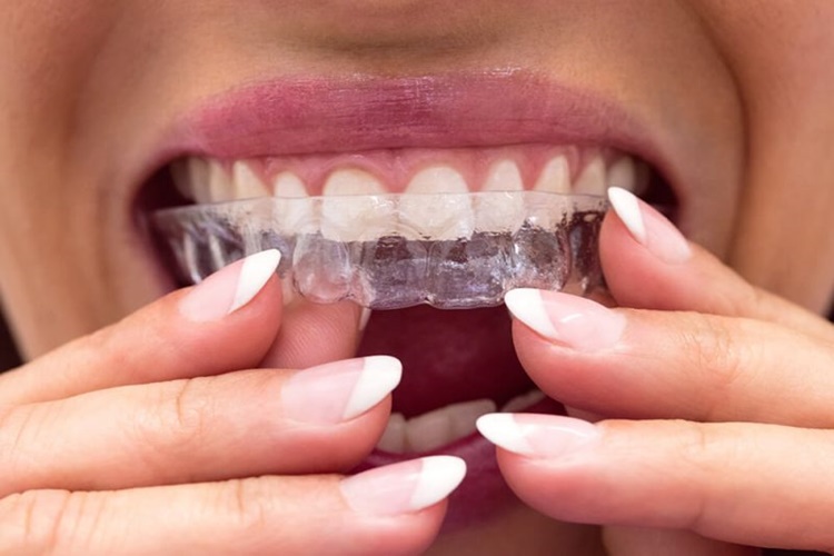 İnvisalign Devlet Karşılıyor Mu?