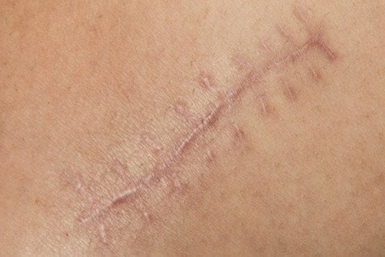 Jilet İzine Hangi Krem İyi Gelir?