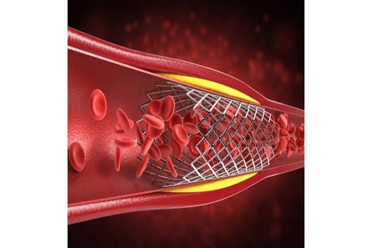 Kalbe Stent Takıldıktan Sonra Cinsel Hayat Konusunda Dikkat Edilmesi Gerekenler Nelerdir?