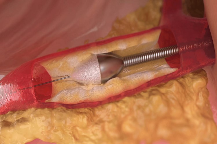 Kalbe Stent Takılması Ne Kadar Sürer?