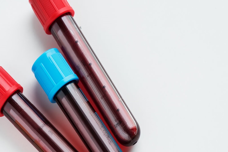 Kan Uyuşmazlığı Testi Neden Yapılır?