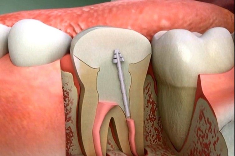 Kanal Tedavisi Sonrası Ağrı Nasıl Geçer?