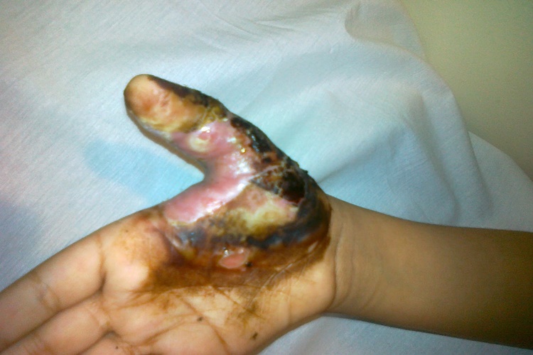 Kangren İçin Hangi Doktora Gidilir?