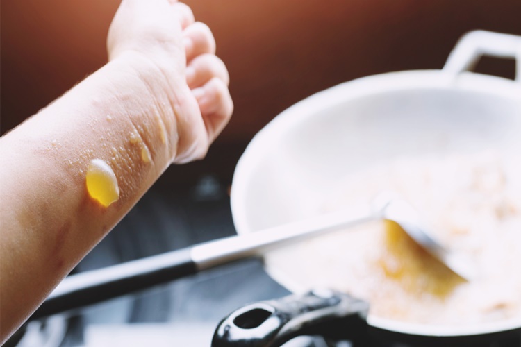 Kantaron Yağı Yanığa İyi Gelir Mi?