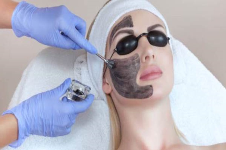 Karbon Peeling Sivilceye İyi Gelir Mi?