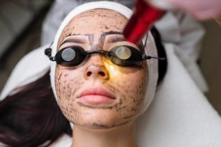 Karbon Peeling Tüyleri Sarartır Mı?