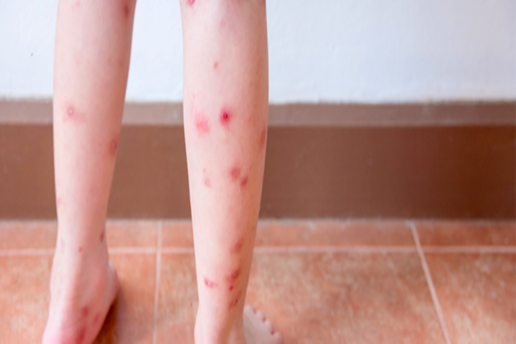 Kaşıntı Lekelerine Ne İyi Gelir?