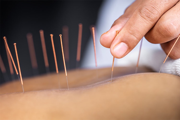 Kuru İğne Tedavisi Nedir?