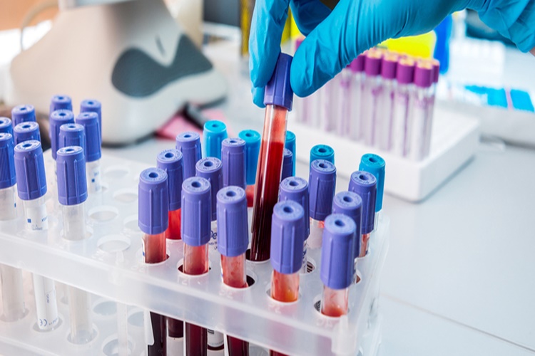 Leptin Hormonu Nasıl Ölçülür?