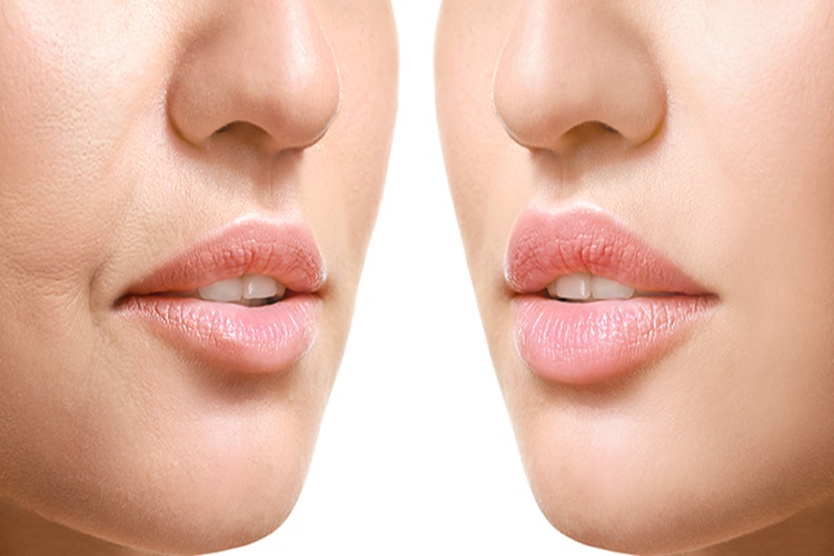 Lip Lift Kalıcı Mı?