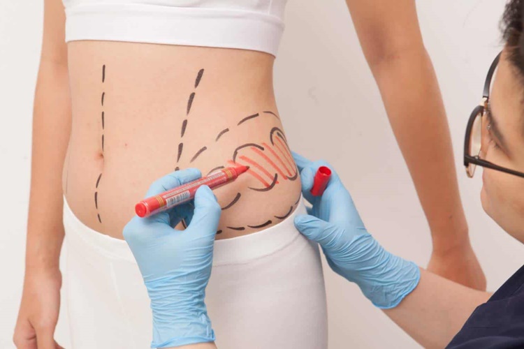  Liposuction ile Ne Kadar Yağ Alınır? 