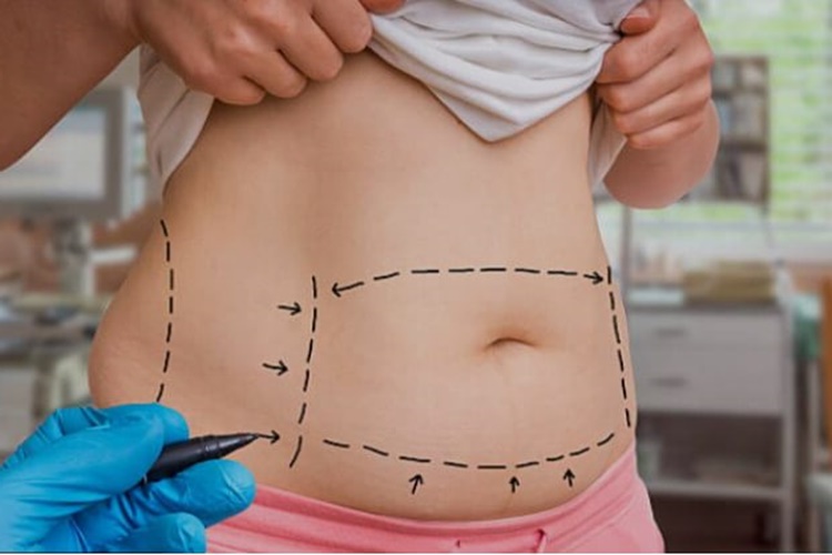  Liposuction ile Zayıflama Nasıl Yapılır?