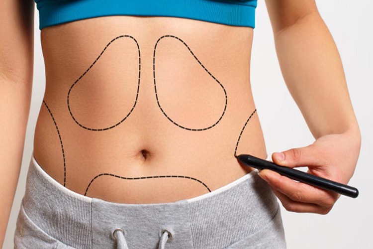 Liposuction Nedir?