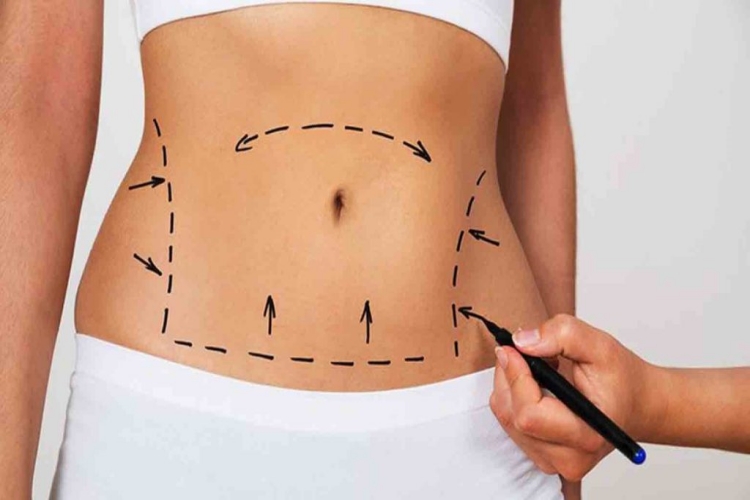 Liposuction Öldürür MÜ?